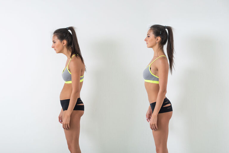 Woman,With,Impaired,Posture,Position,Defect,Scoliosis,And,Ideal,Bearing.